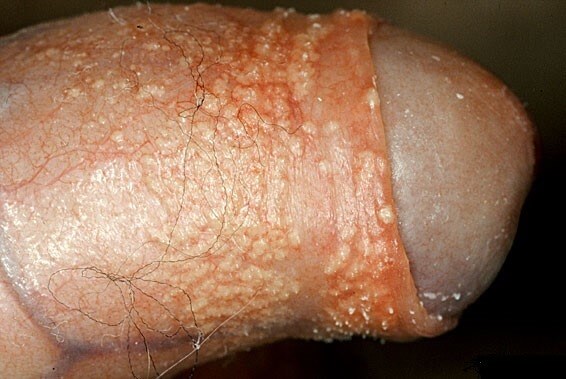 اختلالات شایع پوستی آلت تناسلی مردانه
