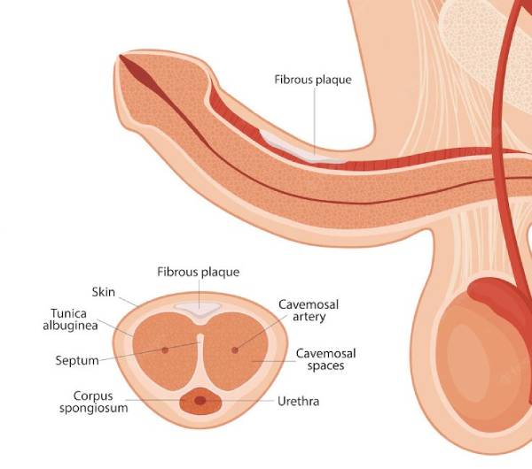 آیا کجی آلت تناسلی خطرناک است؟