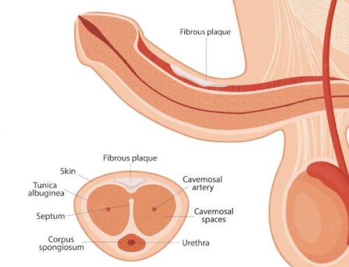 از کجا بفهمم کجی آلت من طبیعی است؟