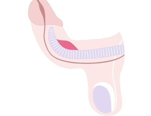 بهترین روش درمان بیماری پیرونی بدون جراحی چیست؟