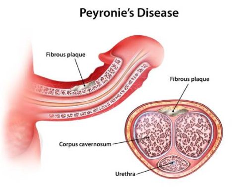 درمان پیرونی با دارو بهتر است یا دستگاه؟