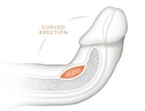 درمان کجی آلت تناسلی