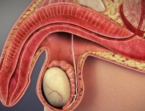 کجی آلت تناسلی به سمت پایین